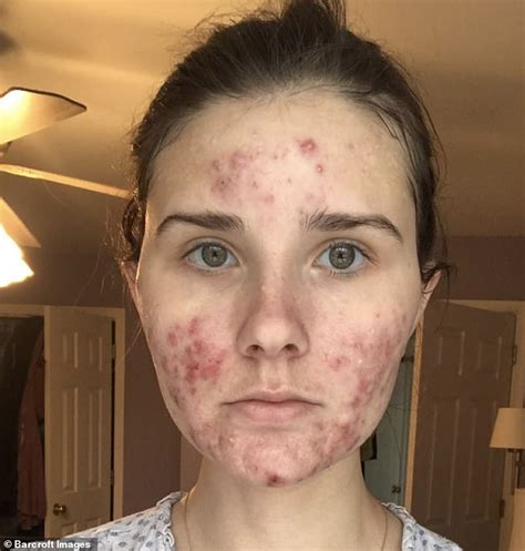 Stylist With Severe Cystic Acne Goes Out Without Makeup For The