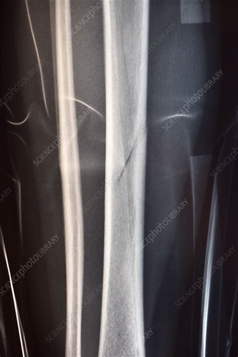 Fractured Shin Bone X Ray Stock Image C0345515 Science Photo