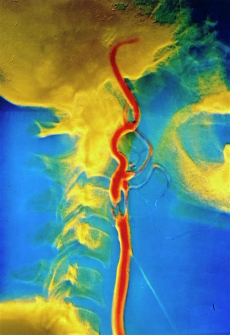 False Colour Angiogram Of Human Neck Photograph By Alain Pol Ism