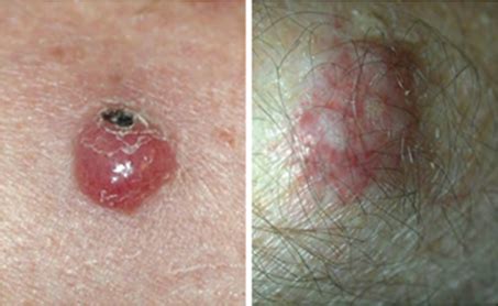 It usually develops as a single. Merkel Cell Carcinoma Warning Signs and Images - The Skin ...