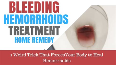 bleeding hemorrhoids treatment home remedy 48 hour cure youtube