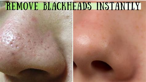 How To Remove Blackheads On Nose Naturally At Home Home