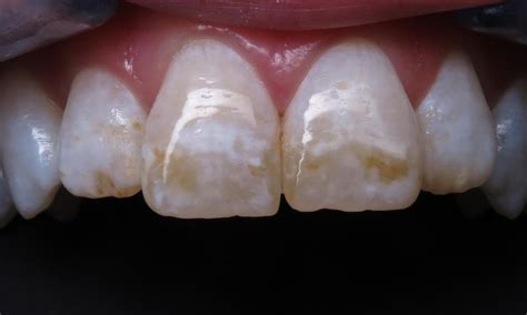 Brown Stains On Teeth Removal Teethwalls