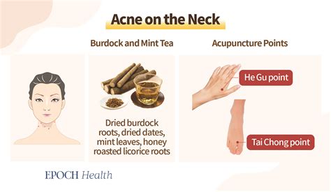Body Acne These Key Locations Signify Health Issues