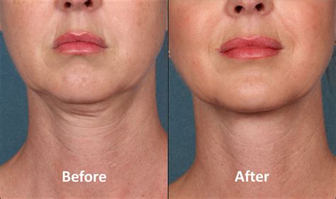National Laser Institute To Offer Breakthrough Kybella Injectable