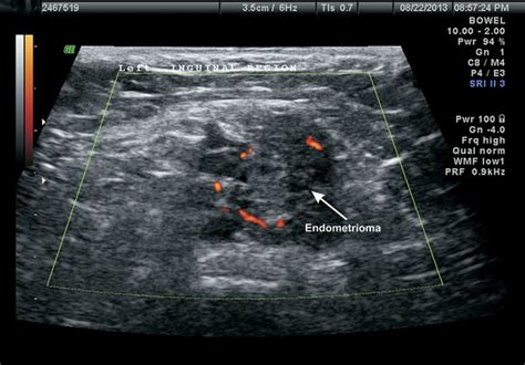 Jack In The Box Inguinal Endometriosis Bmj Case Reports