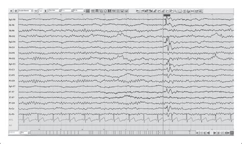 Jle Epileptic Disorders A Child With Ictal Vocalizations And