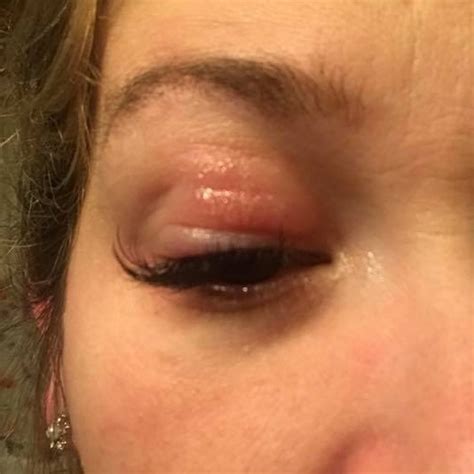 dry flaky eyelids after lash extensions but the salon says it s not to blame