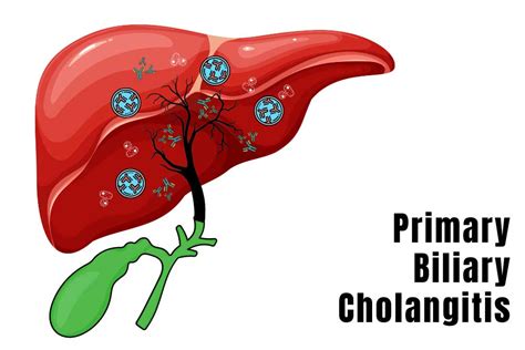 What Is Primary Biliary Cholangitis Encore Research Group