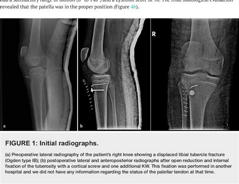 Figure 1 From Neglected Rupture Of The Patellar Tendon After Fixation