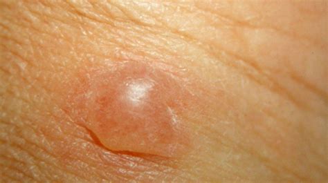 21 Types Of Skin Lesions Pictures Causes And More Skin Bumps Skin