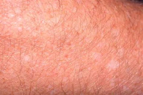 White Spots On Skin Patches Pictures Small Sun Fungus