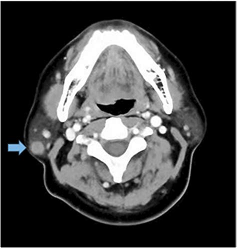 Malignant Melanotic Nerve Sheath Tumor Of The Parotid Gland A Case