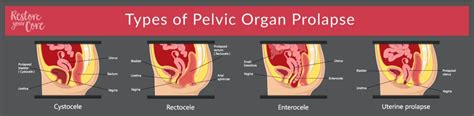 Prolaps Recti Uterine Prolapse Pelvic Organ Prolapse Prolapsed Uterus Sexiz Pix