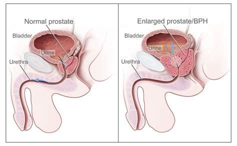 Benign Prostatic Hyperplasia Bph Laptrinhx News
