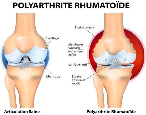 La Polyarthrite Rhumatoïde Causes Symptômes Et Traitements Information Hospitalière