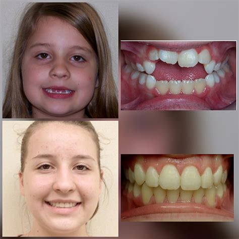Braces Lips Before And After Lipstutorial Org