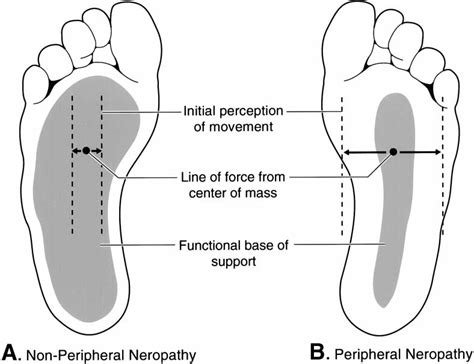 Sole Of The Foot In A Nonperipheral Neuropathy Center Of Mass