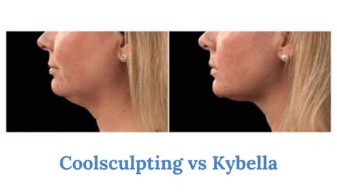 Coolsculpting Vs Kybella For Your Chin Vujevich Dermatology