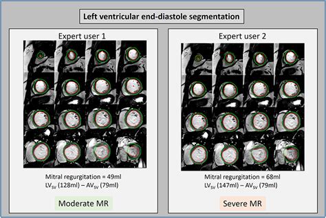 Frontiers A Systematic Review Of 4D Flow MRI Derived Mitral