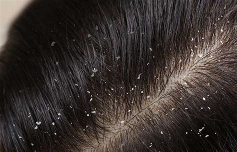 Scalp Problems Causes Symptoms Types And How To Take Care