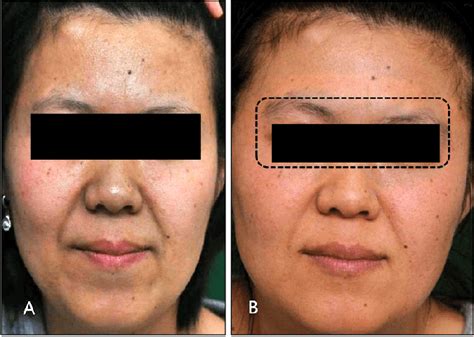 A Blue Gray Pigmentation Of The Face B Significant Improvement