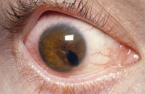 Multiple Colobomata Of The Iris Or Polycoria Congenitalis Is A