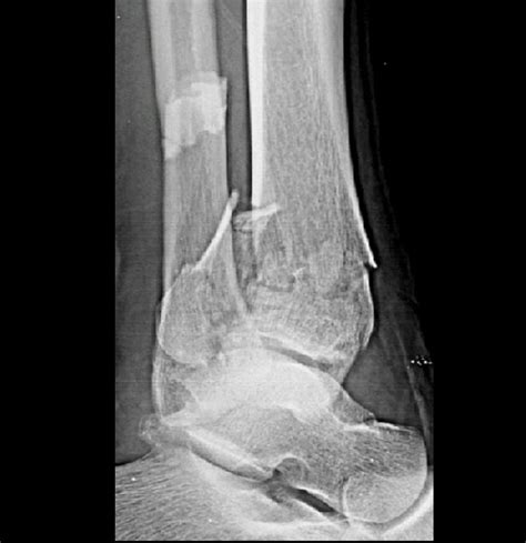 Lateral Distal Tibia Fracture