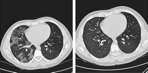 High Resolution Computed Tomography Hrct A Few Months Apart The