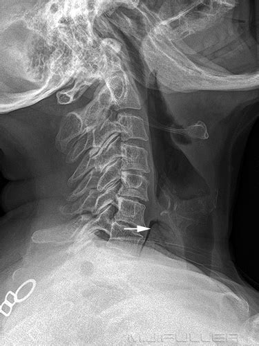 Lateral Soft Tissue Neck for Foreign Body - wikiRadiography