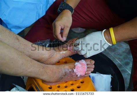 Hands Doctors Cleaning Infected Wounds Legs Stock Photo 1111675733