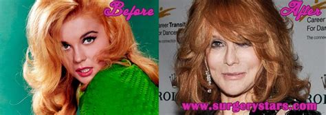 Ann Margret Plastic Surgery Before After Photos