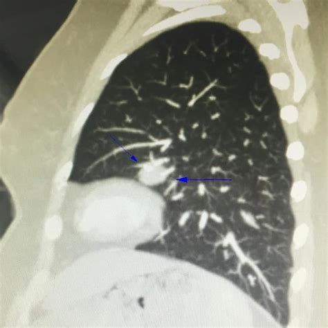 Thorax Computed Tomography Showing A X Mm Solid Nodule In Left Lung