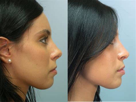 Nose Plastic Surgery Cost In Canada at Robert Knowles blog