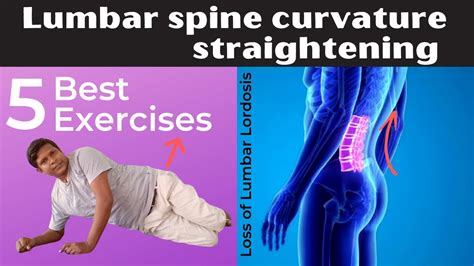 5 Best Loss Of Lumbar Lordosis Correction Exercises Lumbar Spine Curvature Exercise Youtube