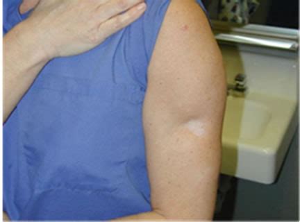 Treatment of Steroid Induced Lipoatrophy with Structural Fat Grafting