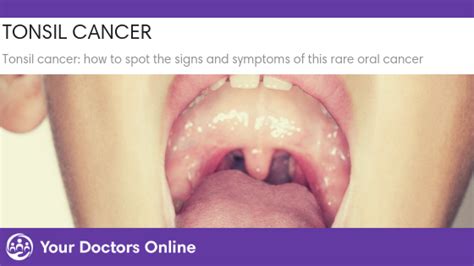 Tonsil Cancer Signs Symptoms And Treatment