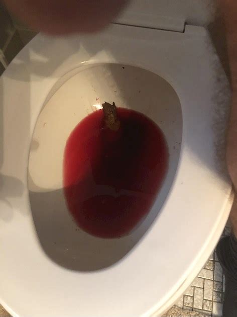 A Lot Of Red Blood In Stool