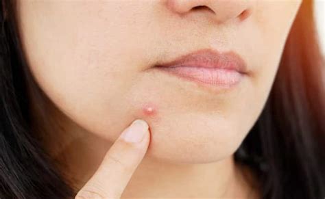 Skincare What Are Blind Pimples 7 Tips To Get Rid Of Them