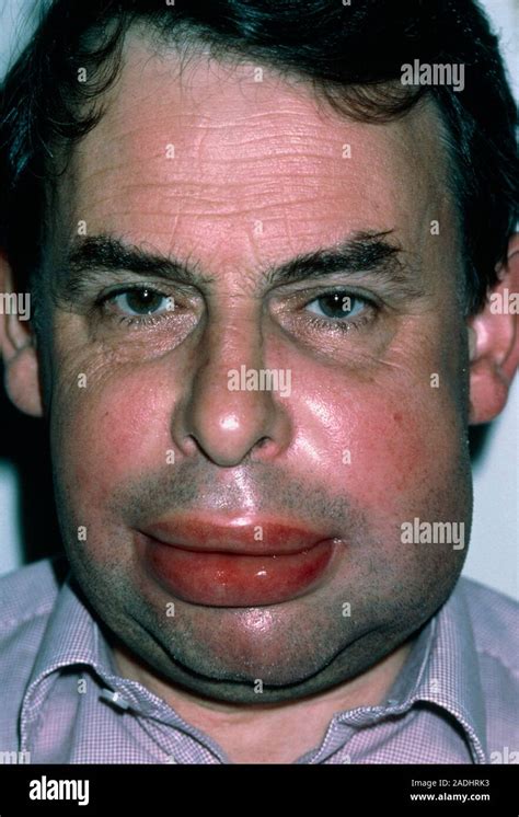 Angioedema Severe Swelling In The Lower Face Of A 50 Year Old Man