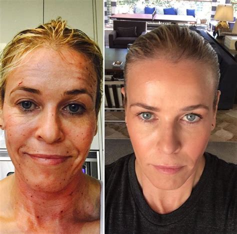 Chelsea Handler Reveals Profractional Laser Skin Results And They Re Pretty Amazing Chelsea