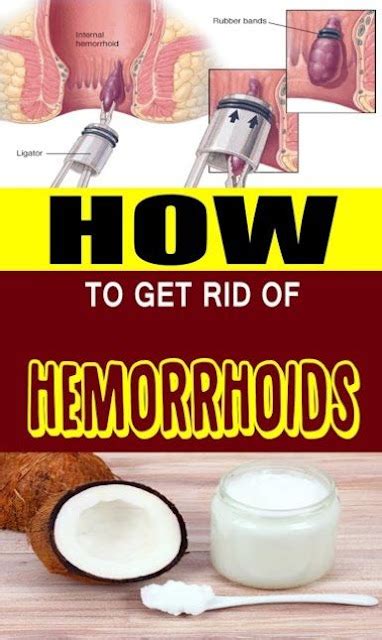 How To Get Rid Of Hemorrhoids Without Surgery