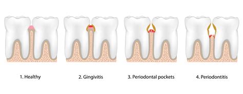 Lake Jackson Tx Gum Disease And Tooth Loss Missing Teeth And
