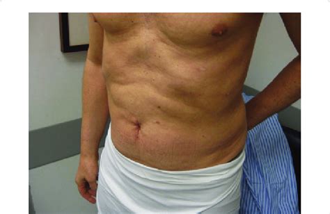 The Figure Depicts The Postoperative Umbilical Incision Of A Patient 8