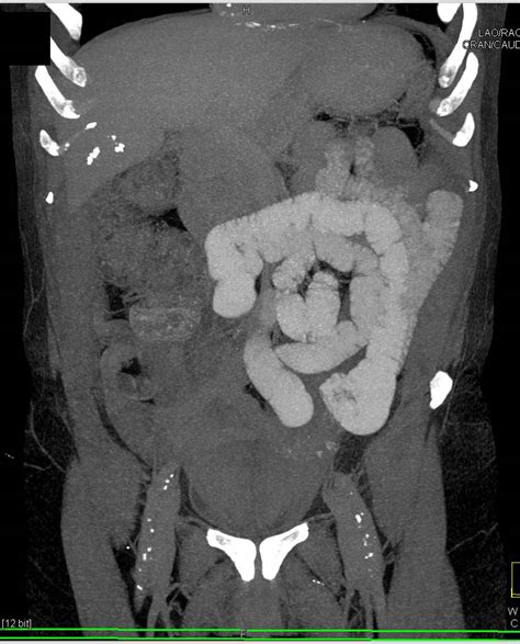 3d Vrt Of Normal Small Bowel Small Bowel Case Studies Ctisus Ct