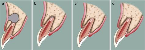 Variations In Outcome Of Endodontic Surgery Pocket Dentistry