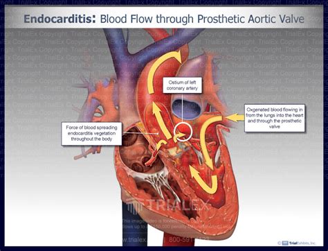 Endocarditis Blood Flow Through Prosthetic Aortic Valve