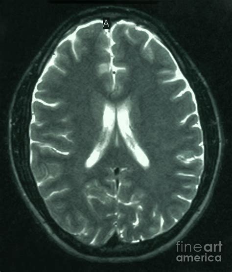 Mri Showing Normal Brain Photograph By Science Source Pixels