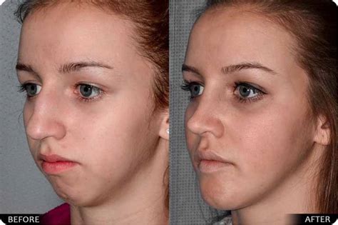 Jaw Surgery Guilford Ct Orthognathic Surgery Facial Contouring