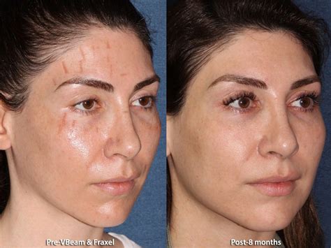 Scar Treatment San Diego Ca Cosmetic Laser Dermatology